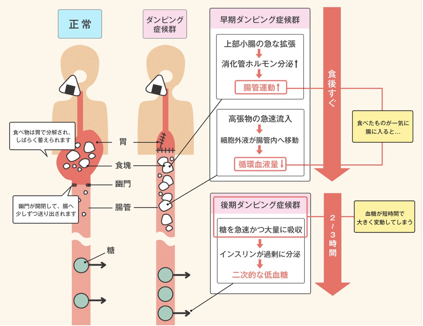 正常な消化とダンピング症候群のメカニズムが、胃、腸管、および時間の経過を示す図とフローチャートで比較。正常:食べ物は胃で分解され、しばらく蓄えられます。(食塊として示されています)幽門が開き、少しずつ腸管へ送り出されます。腸管では糖が吸収されます。ダンピング症候群:ダンピング症候群は早期ダンピング症候群と後期ダンピング症候群に分けられます。早期ダンピング症候群: 上部小腸の急な拡張、消化管ホルモン分泌増加、腸管運動増加、高張物の急速流入、細胞外液が腸管内へ移動、循環血液量減少。後期ダンピング症候群: 食後2〜3時間後の反応、糖を急速かつ大量に吸収、インスリンが過剰に分泌、二次的な低血糖。
