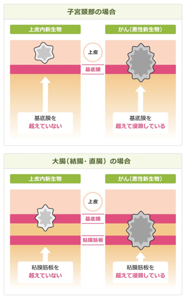部位別の上皮内新生物とがん（悪性新生物）の違い