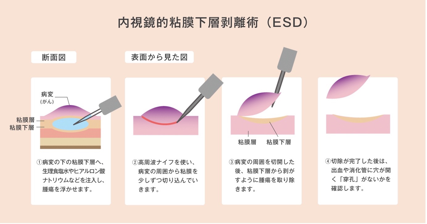 内視鏡的粘膜下層剥離術(ESD)の断面図と表面から見た図による説明:1:病変(がん)の下の粘膜下層へ生理食塩水やヒアルロン酸ナトリウムなどを注入し腫瘍を浮かせます、2:高周波ナイフを使い病変の周囲から粘膜を少しずつ切り込んでいきます、3:病変の周囲を切開した後粘膜下層から剥がすように腫瘍を取り除きます、4:切除が完了した後に出血や消化管に穴が開く「穿孔」がないかを確認します。