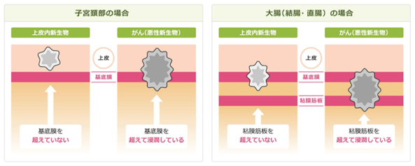 部位別の上皮内新生物とがん（悪性新生物）の違い
