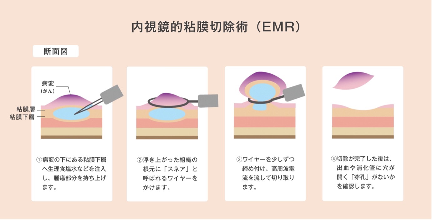 内視鏡的粘膜切除術(EMR)の断面図による説明:1:病変(がん)の下にある粘膜下層へ生理食塩水などを注入し腫瘍部分を持ち上げます、2:浮き上がった組織の根元に「スネア」と呼ばれるワイヤーをかけます、3:ワイヤーを少しずつ締め付け高周波電流を流して切り取ります、4:切除が完了した後は出血や消化管に穴が開く「穿孔」がないかを確認します。