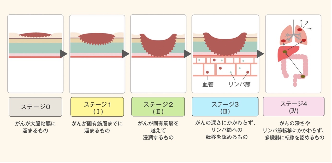 大腸がんのステージ分類を示す図:ステージ0のがんが大腸粘膜に留まるもの、ステージ1(I)のがんが固有筋層までに留まるもの、ステージ2(II)のがんが固有筋層を越えて浸潤するもの、ステージ3(III)のがんが深さにかかわらずリンパ節への転移を認めるもの、ステージ4(IV)のがんが深さやリンパ節転移にかかわらず多臓器に転移を認めるもの。