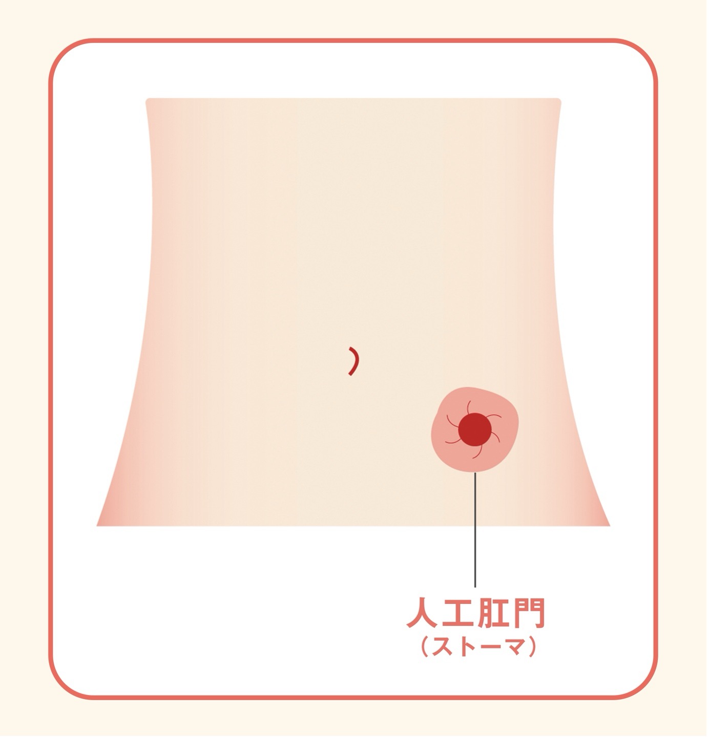 人工肛門(ストーマ)の図。右下腹部に、人工肛門(ストーマ)と呼ばれる赤く丸い開口部がある。